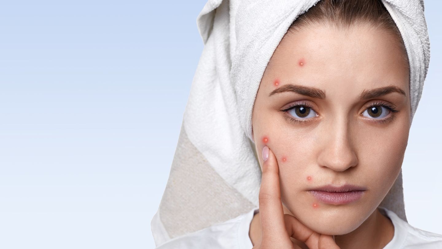 Les bienfaits des patchs boutons pour une peau sans imperfections - Beaute Lumiere